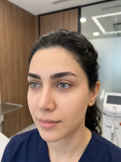 زاویه‌سازی فک و صورت با فیلر