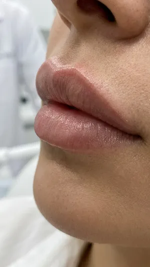 تزریق ژل لب متد روسی برای حجم‌دهی طبیعی