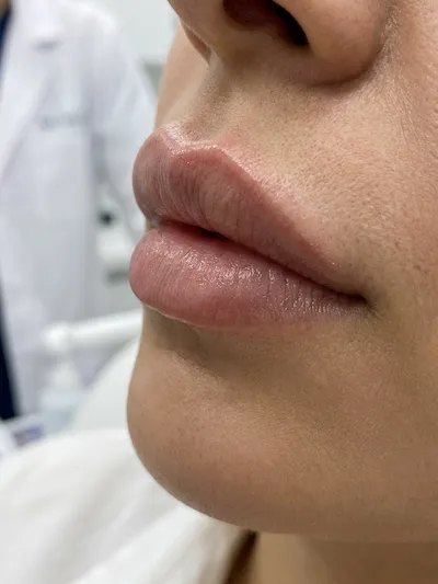 تزریق فیلر لب روسی (Russian Lips)